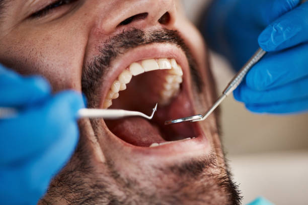 Best Emergency Wisdom Teeth Removal in Lake Station, IN